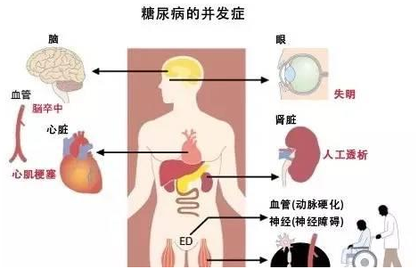 老年糖尿病有何特点？如何识别？3.png